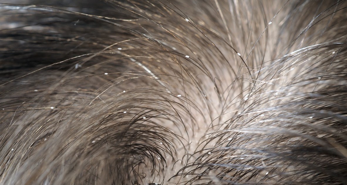 How Long Does Lice Live Without A Host Head Lice Causes Symptoms And