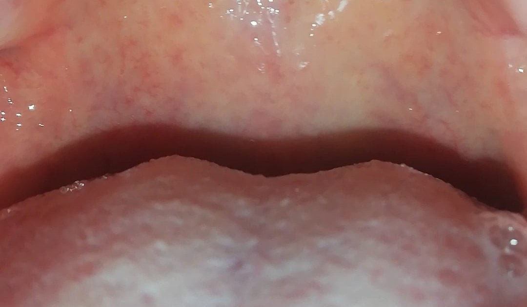 Tiny Bumps On Mouth Roof Herpangina Wikipedia Often These Bumps