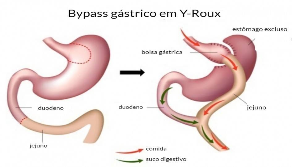 Roux En Y Gastric Bypass ~ Oficina De Medicina