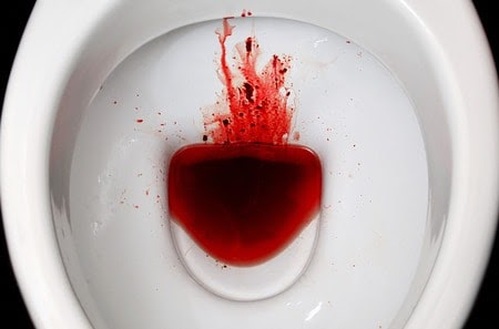Blood In Stool After Drinking Alcohol Reddit