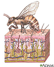 Illustration of a bee with stinger in the skin