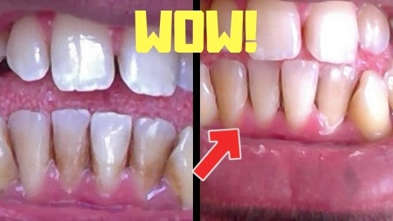 Remove Brown Stains In Between Teeth Teethwalls 