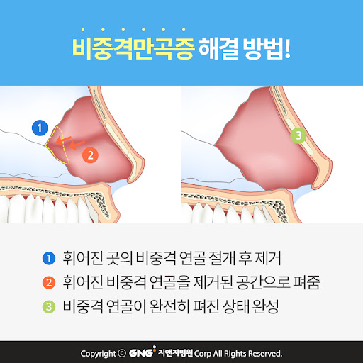 비중격편위수술 비용 걱정 덜한 경험 많은 병원으로