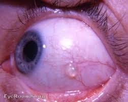 There S A Bump On My Eye Part 2 Conjunctival Cyst Eyedolatry