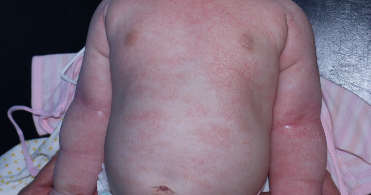 [最も共有された！ √] 赤ちゃん 体幹 湿疹 323969赤ちゃん 体幹 湿疹 Joshimagesfpi