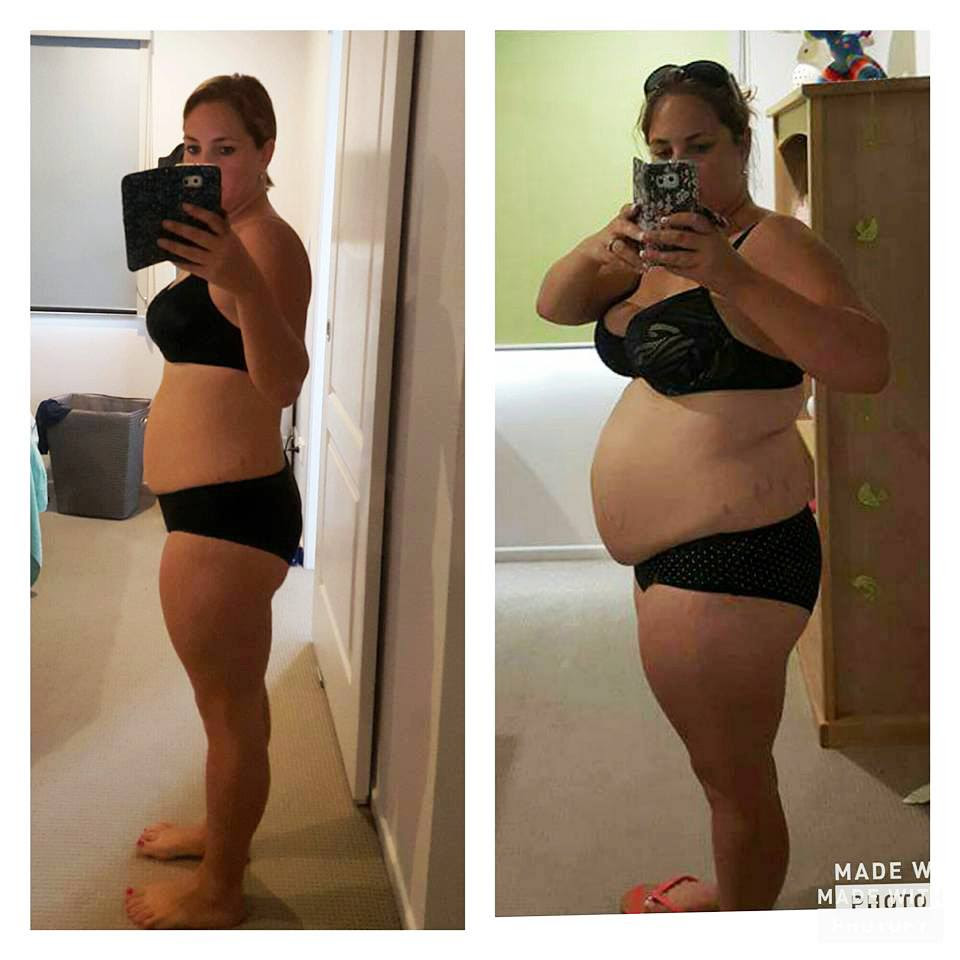 abdominal pcos depressed diets