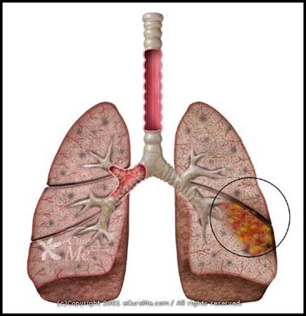 pneumonia bronchial children lungs lung diagram smoker infection weed cancer nigerian health smoking drawing heart anatomy thousand annually agency die