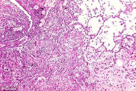 The compound found in sweat is active against many well known pathogens such as tuberculosis (above)