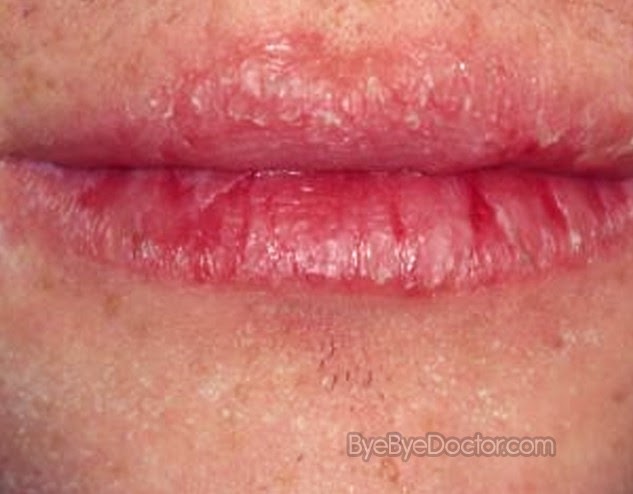 Chapped Lips – Symptoms, Causes, Cure, Treatment, Home  
