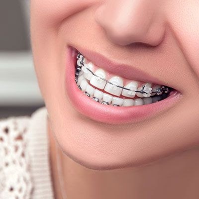 Braces For What: Cheap Braces Near Me With Insurance