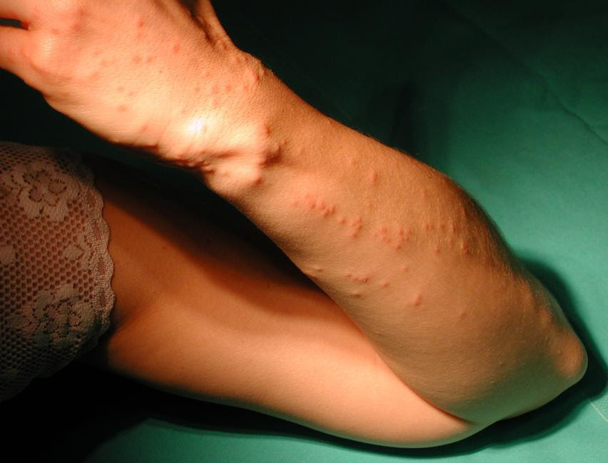 http://onemansblog.com/wp-content/uploads/2007/09/Bedbug_Bites.jpg