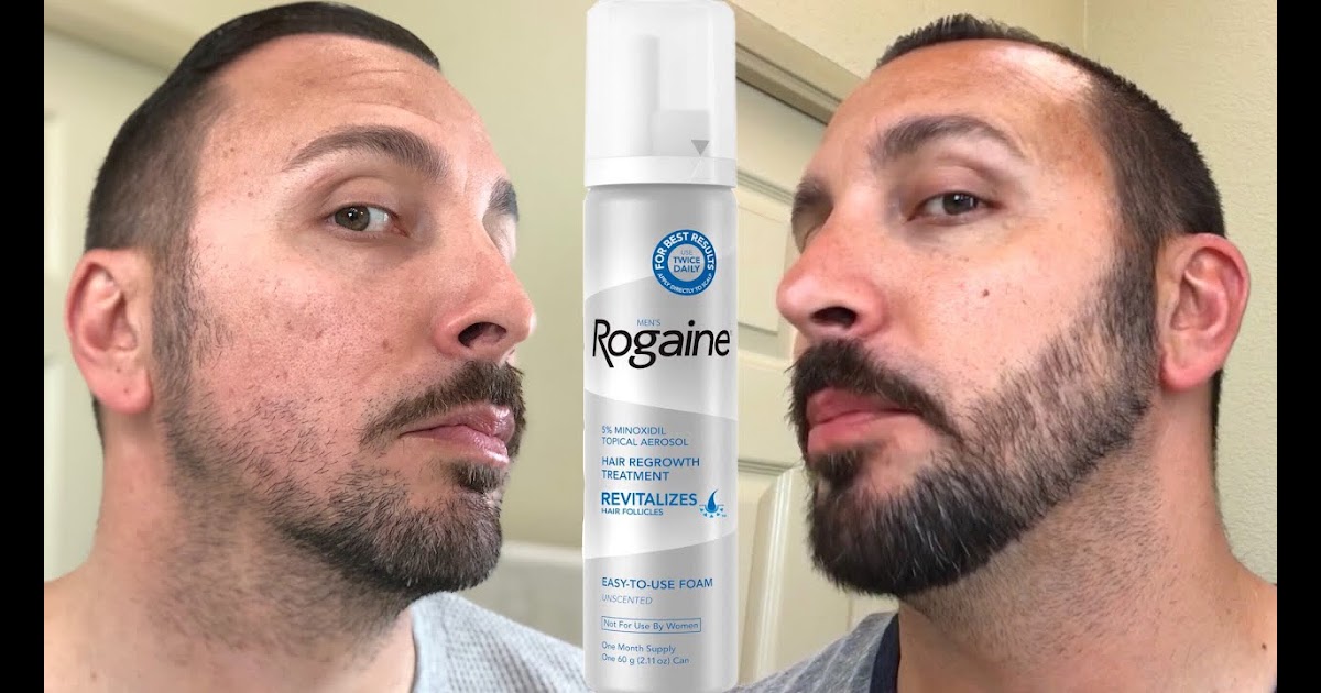 Minoxidil Before And After Beard Result : Beard Before And After