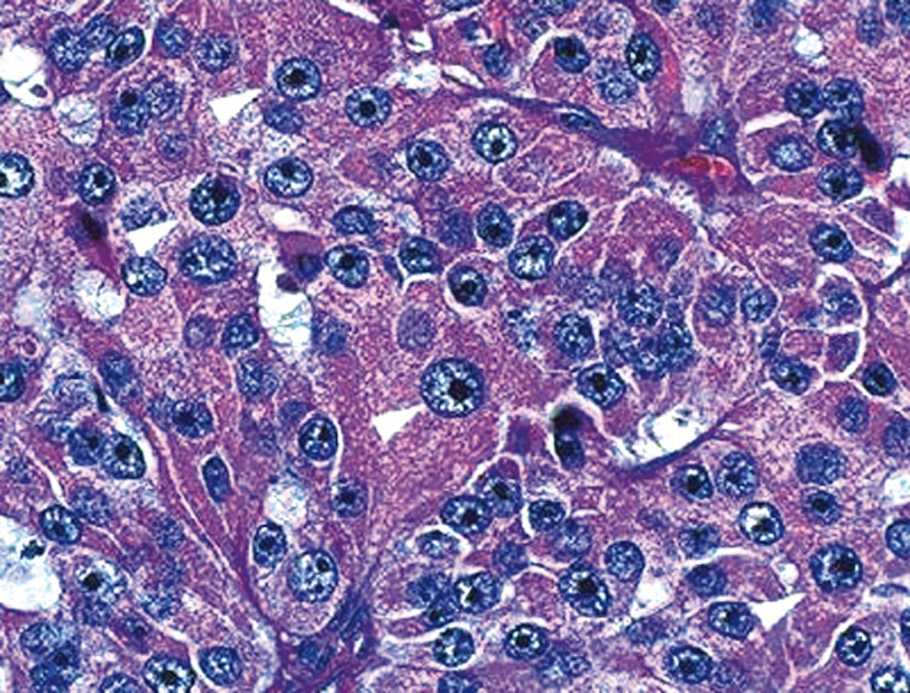 Pathology Outlines Oncocytic Hurthle Cell Tumors