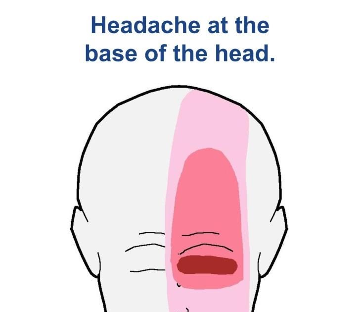 Headache Behind The Head And Neck - Cluster Headaches