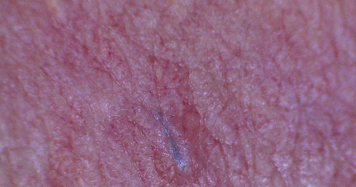 eingewachsene haare nach epilieren
