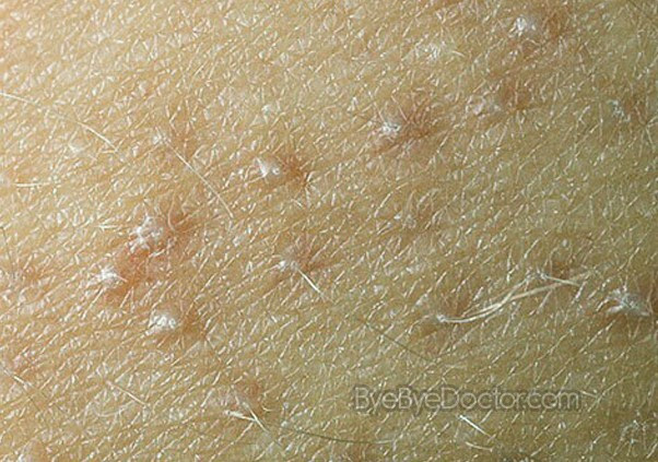 Pimples On Arms Causes Treatment Pictures Symptoms Causes