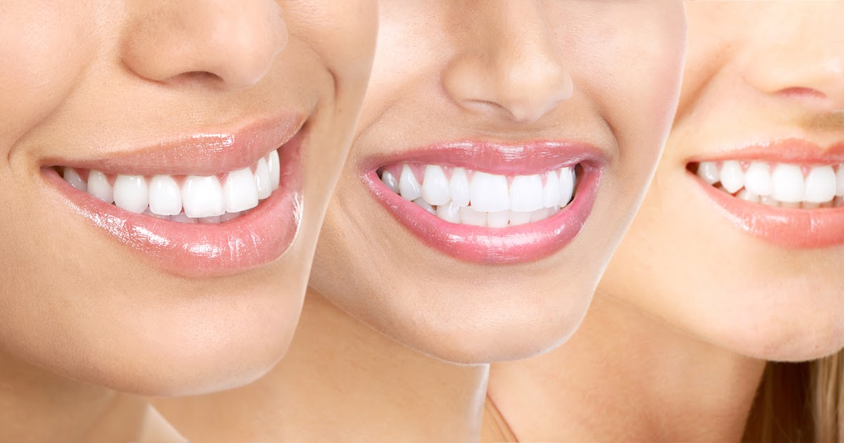 Tips To Teeth Whitening - 600 Tips