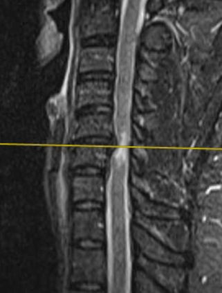 cervical mri chiropractic spine