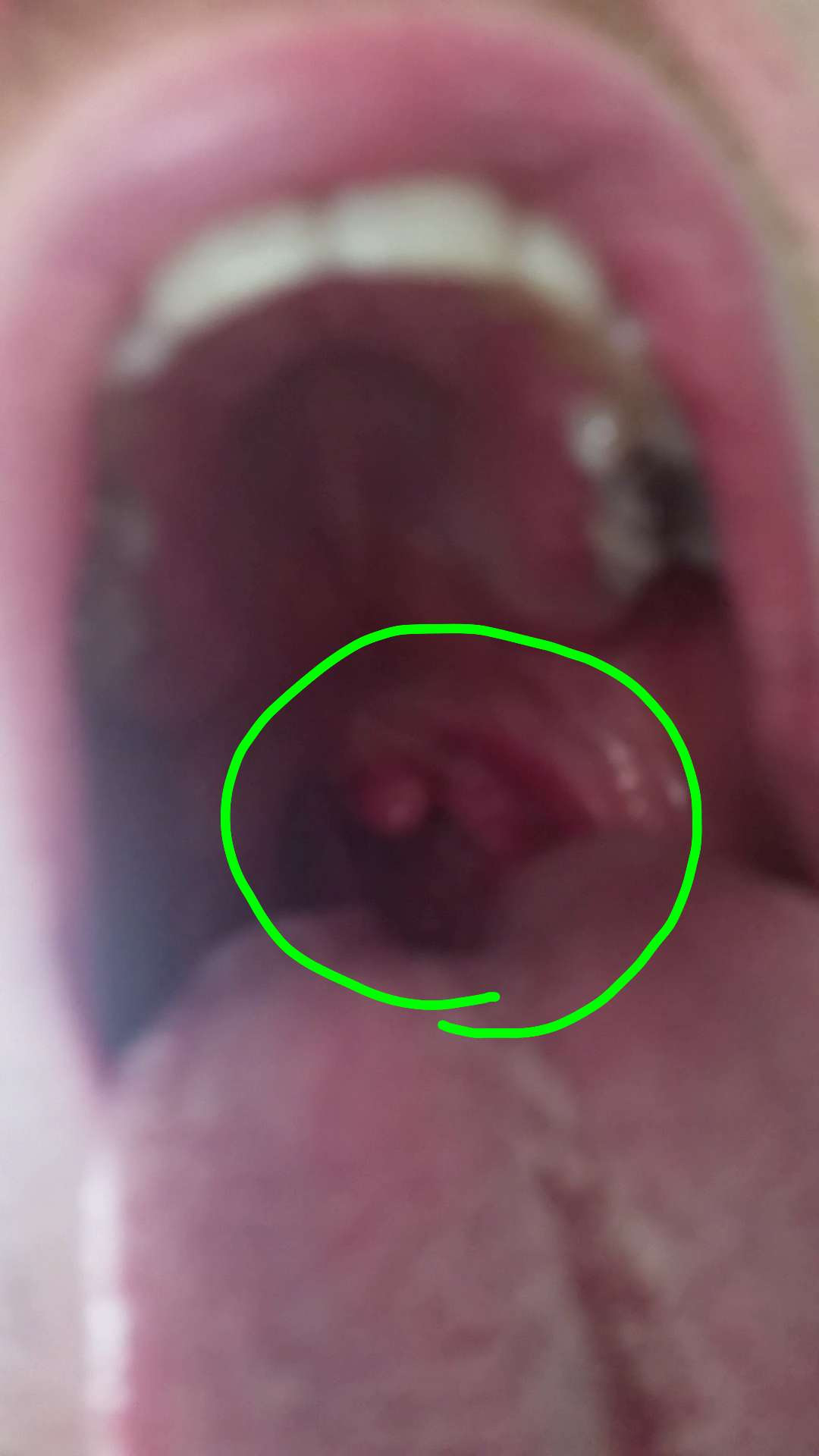White Things On Tonsils Pict Art