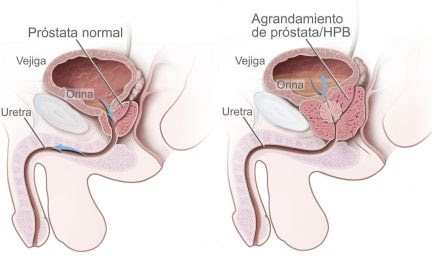 prostata