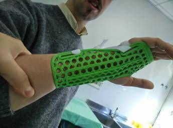 <p>Tutore stampato in 3D</p>