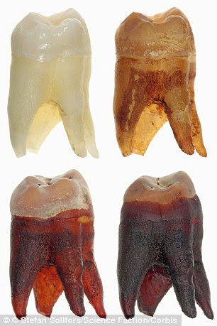 The phosphoric acid in cola drinks erodes away tooth enamel, and the coloring makes the root go dark brown