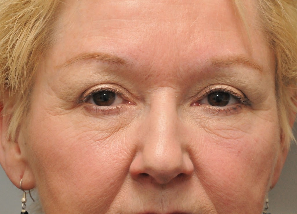 Eyebrow Bone Surgery