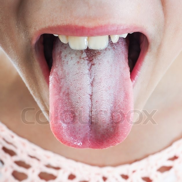 Zungenbelag brauner Das klinische