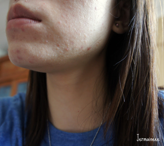 Sponsored Review Zap Those Acne Pimples With Eucerin Jermaineee Livejournal