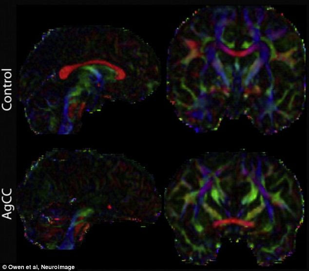 Different brain structures: Example midline sagittal and coronal colour fractional anisotropy (FA) images for a control subject with a normal brain and a patient suffering from agenesis of the corpus callosum