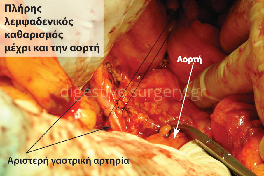 Stomach Cancer Laparoscopic Surgery