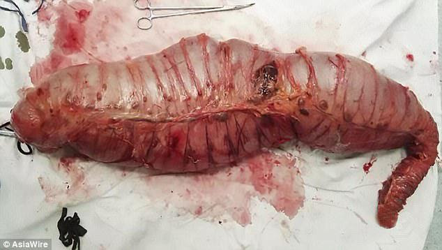 The surgeons at Tenth People’s Hospital of Shanghai in China removed 30 inches of the affected part of his colon (pictured)