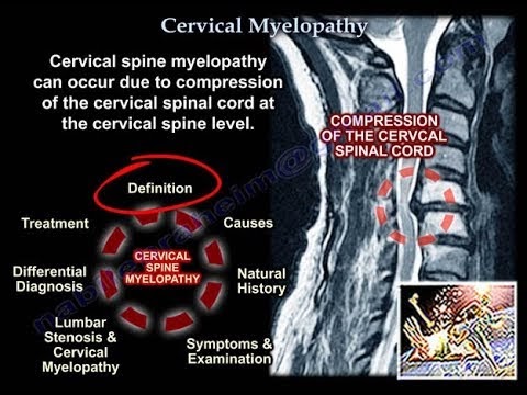cervical myelopathy,what to know?