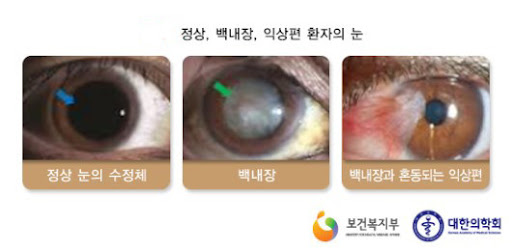 초기 백내장 증상의 6가지 원인 치료 수술 후 관리 4