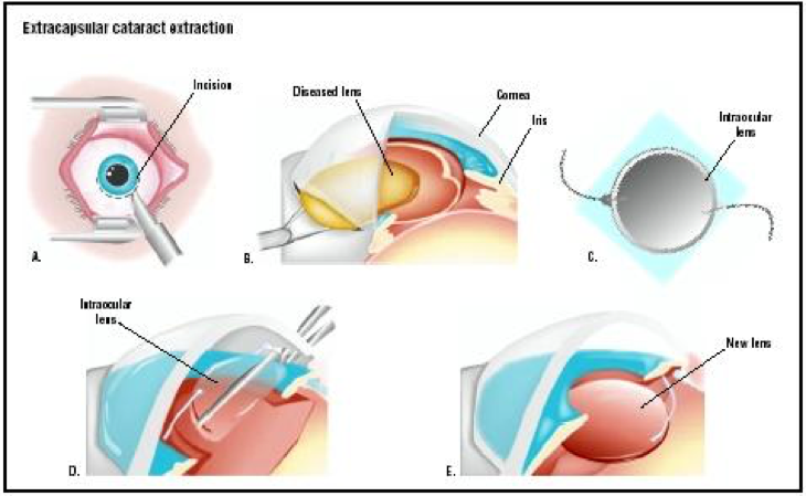 Лечение после операции катаракты. Интраокулярная экстракция катаракты. Экстракапсулярная экстракция катаракты. Этапы экстракапсулярной экстракции катаракты. Лазерная экстракция катаракты офтальмология.