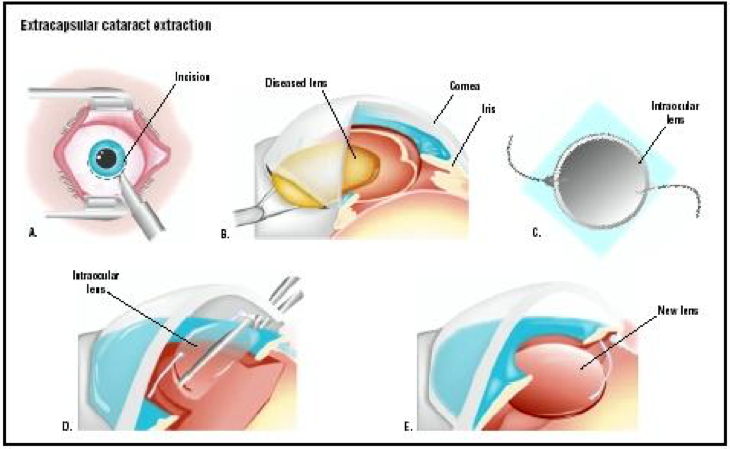 Какая лучше операция катаракта. Интраокулярная экстракция катаракты. Экстракапсулярная экстракция катаракты. Этапы экстракапсулярной экстракции катаракты. Лазерная экстракция катаракты офтальмология.
