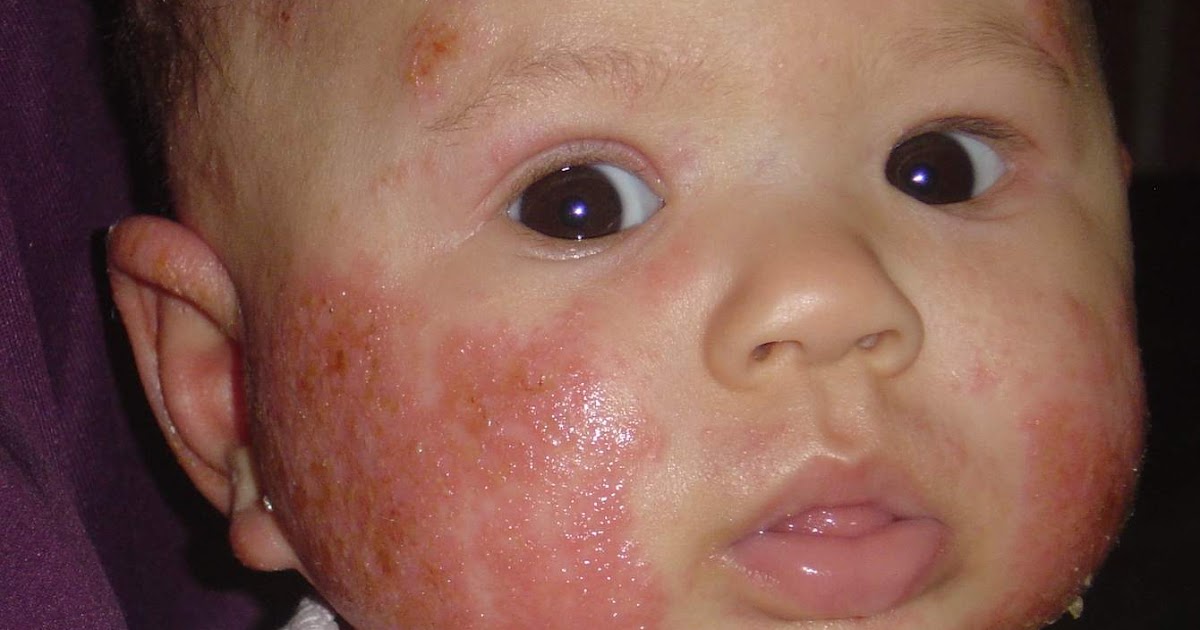 Allergies and neonatal acne baby Acne Picture