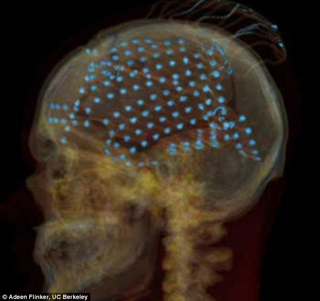 Scientific breakthrough: An X-ray CT scan of the head of one of the volunteers, showing electrodes distributed over the brain's temporal lobe, where sounds are processed