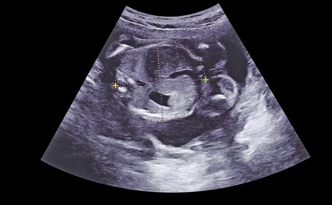 شكل بطن الام الحامل بولد في الشهر الرابع Shakal Blog