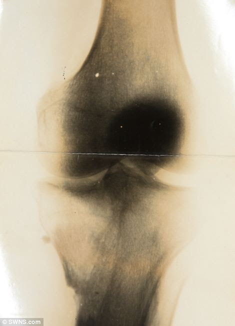 After he was shot in the leg in 1917, these x-rays were taken of his leg, and are thought to have been carried out by Marie Curie, who had a mobile unit where he was treated