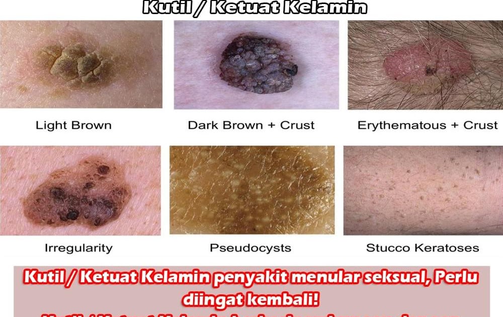 Harga Ubat Kutil Di Farmasi  Gallery