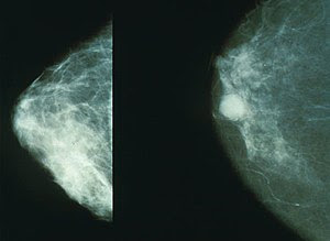 Breast implant: Mammographs: Normal breast (le...