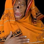 Bashiran-Bibi-acid-attack-victim