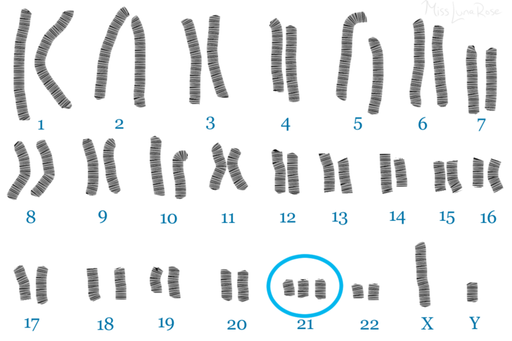 Синдром дауна лишняя хромосома. Синдром Дауна 21 хромосома. Хромосомы при синдроме Дауна. Кариотип 21 хромосомы. Синдром Дауна схема хромосом.