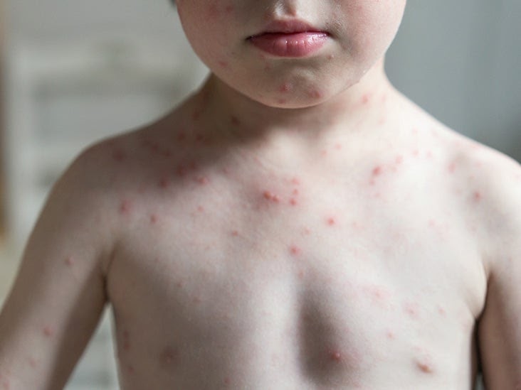 Fever with rash in child: Pictures, causes, and treatments ...
