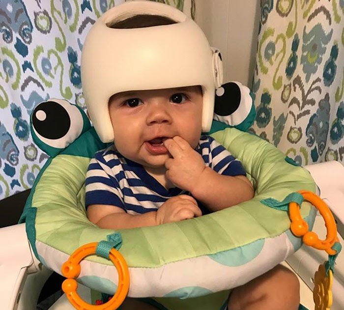 [Trending] This Baby Has To Wear A Helmet So The Whole