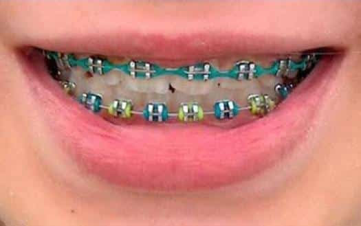 Update Warna Karet Behel yang Lagi Trend Update Warna Karet Behel yang Lagi Trend