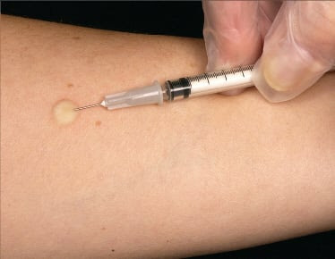 Intradermal Injection (Test for Drug Sensitivity)