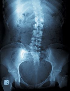 Scoliosis xrays