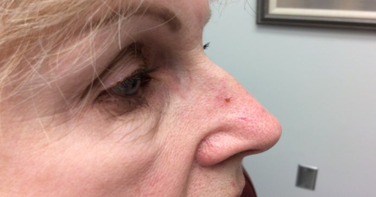 Skin Cancer Pictures On Nose Idaman
